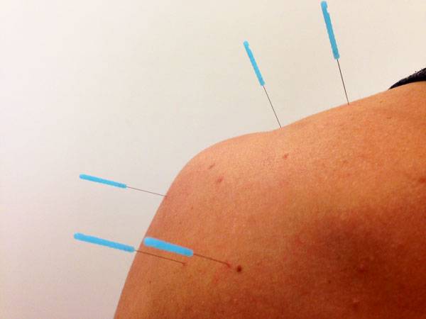 how is dry needling different from acupuncture