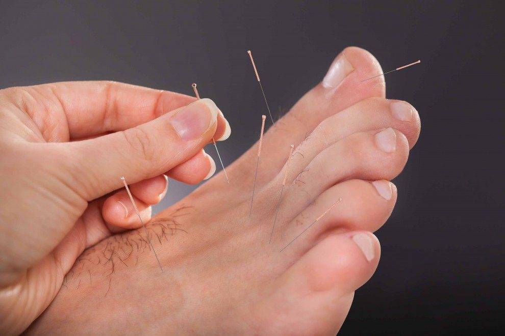 can dry needling help tendonitis