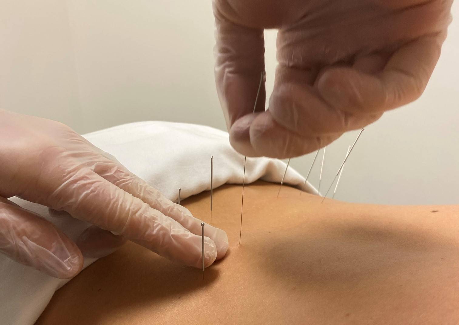 what dry needling does
