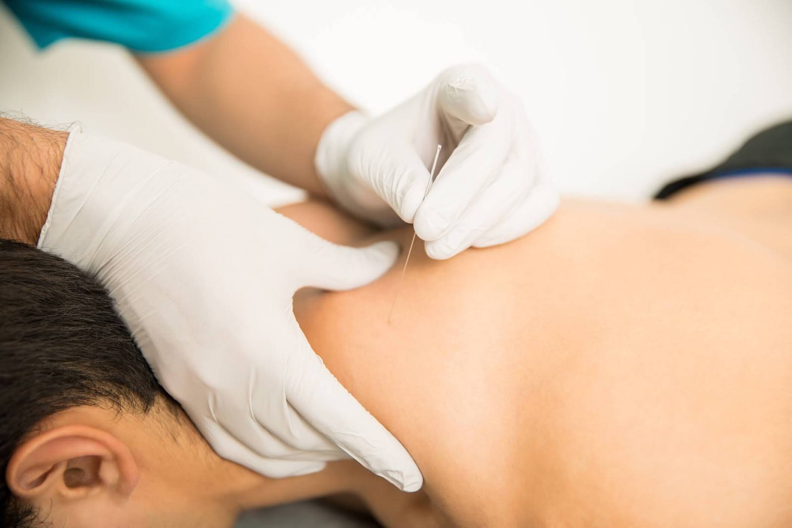 can dry needling cause nerve damage