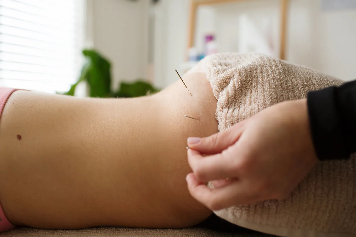 Dry Needling for the Hip Flexor
