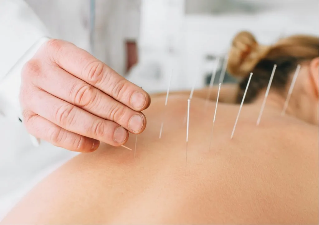 Is Dry Needling Effective